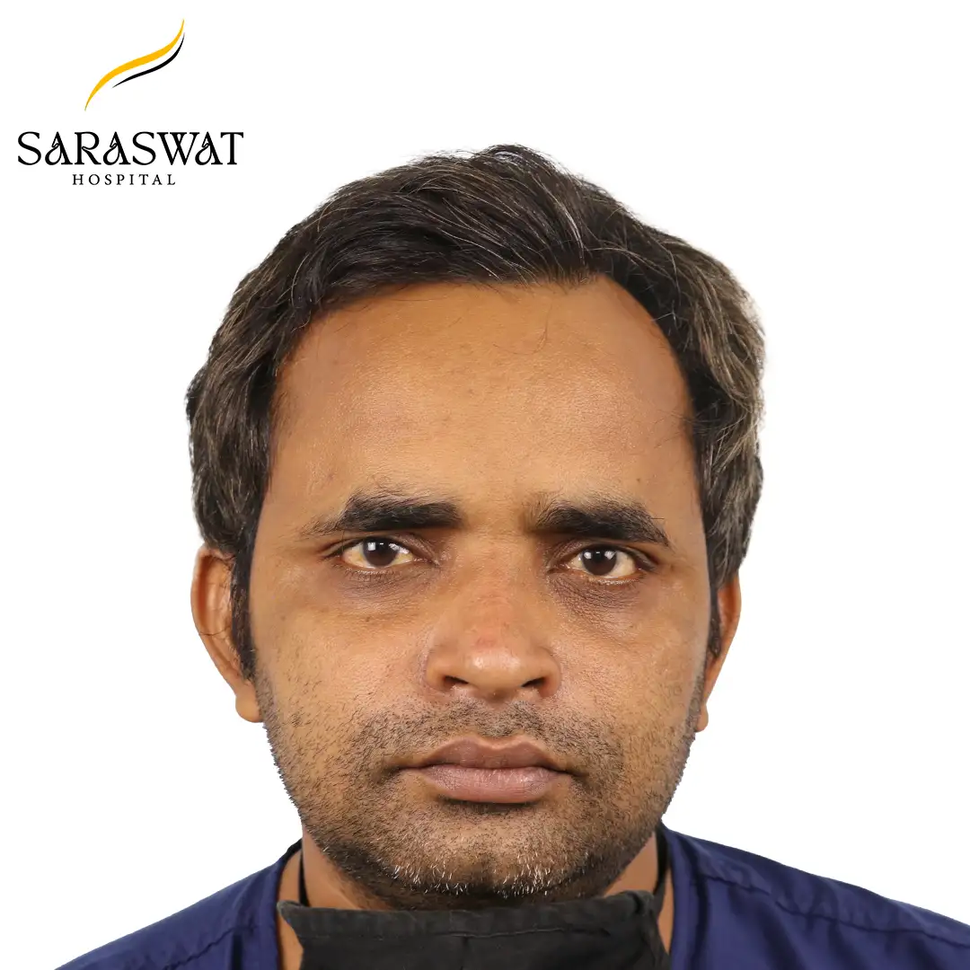 Front FUE Hair Transplant Result Before Procedure