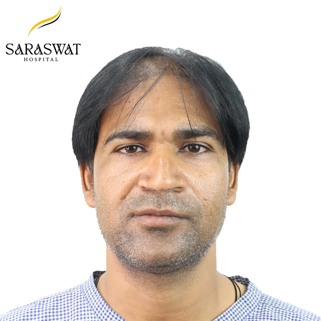 Front FUE Hair Transplant Result Before Procedure