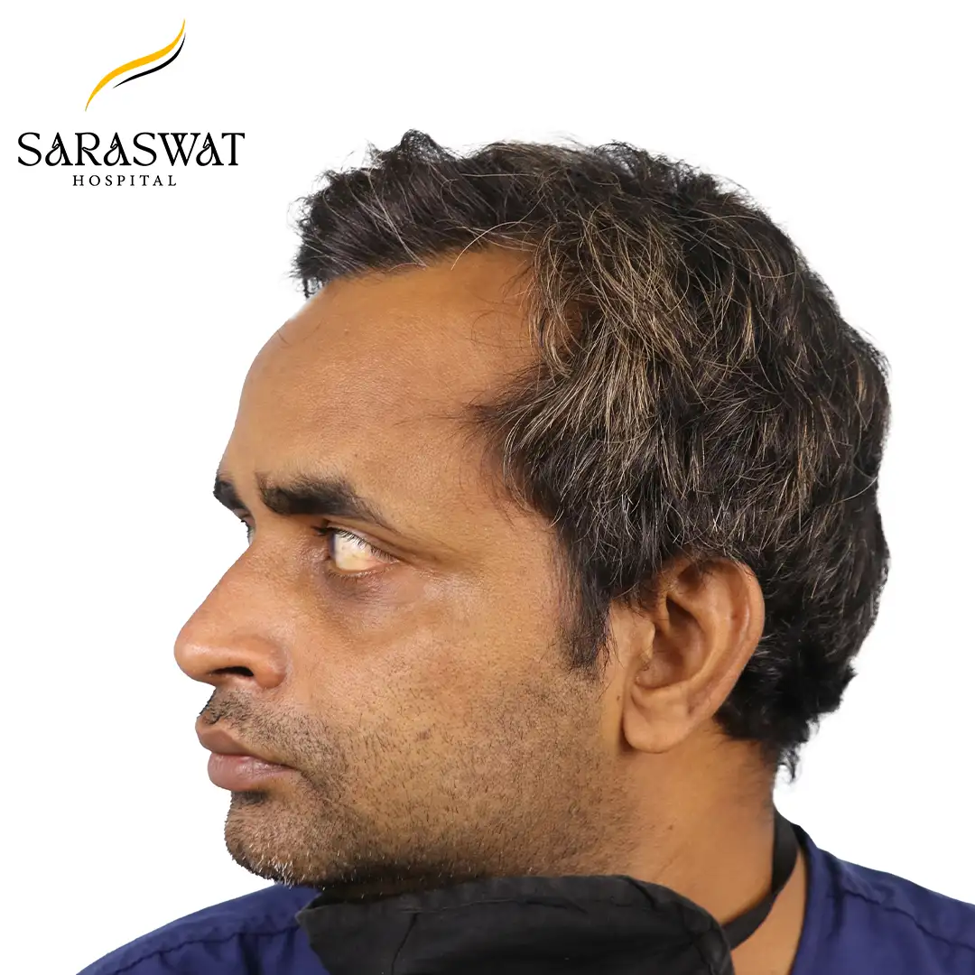 90 Degree Left FUE Hair Transplant Result Before Procedure