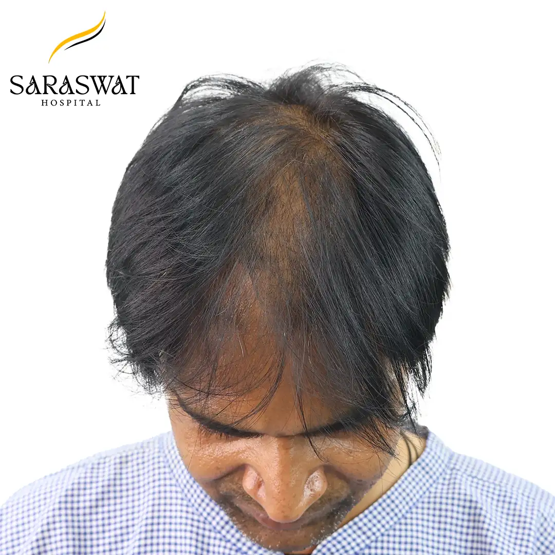 Top FUE Hair Transplant Result Before Procedure