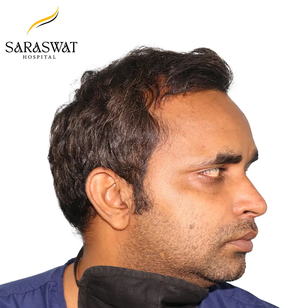 90 Degree Right FUE Hair Transplant Result Before Procedure