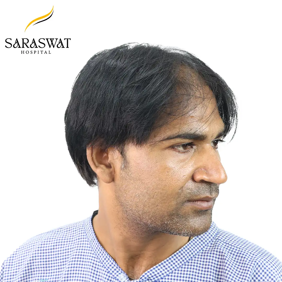 Hair Transplant Before and After Results