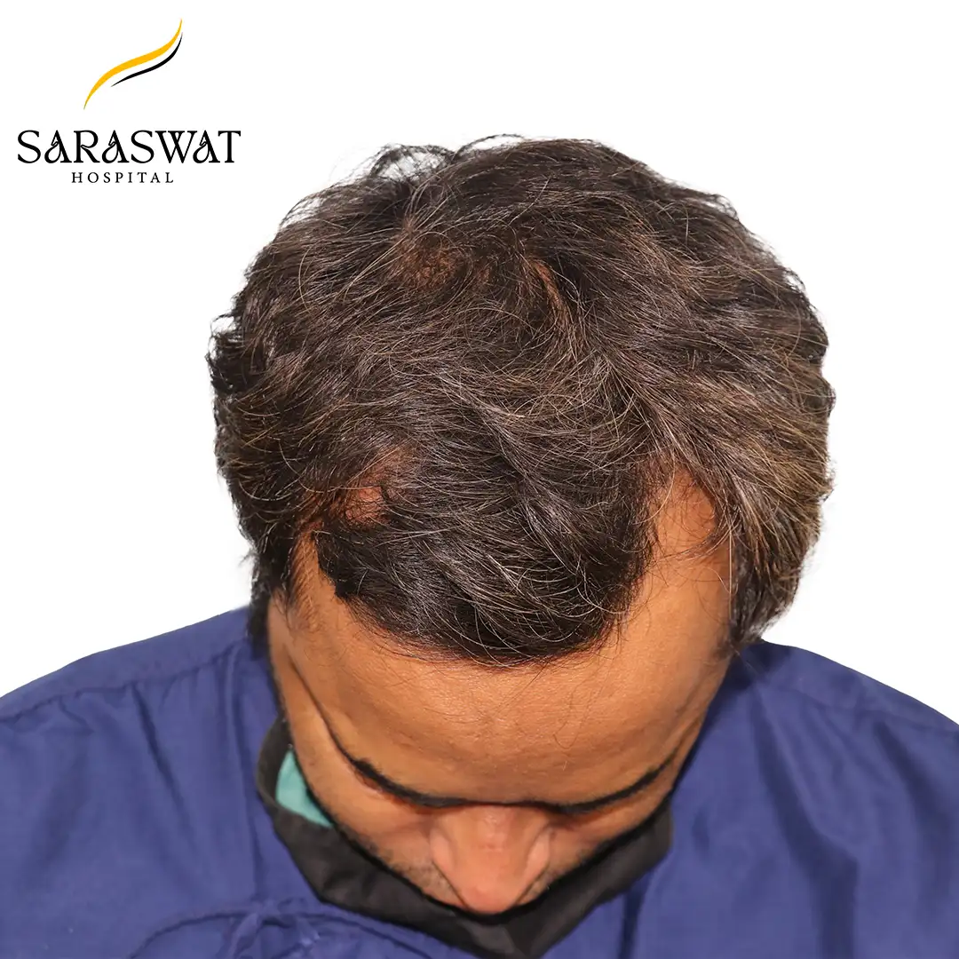 Top FUE Hair Transplant Result Before Procedure