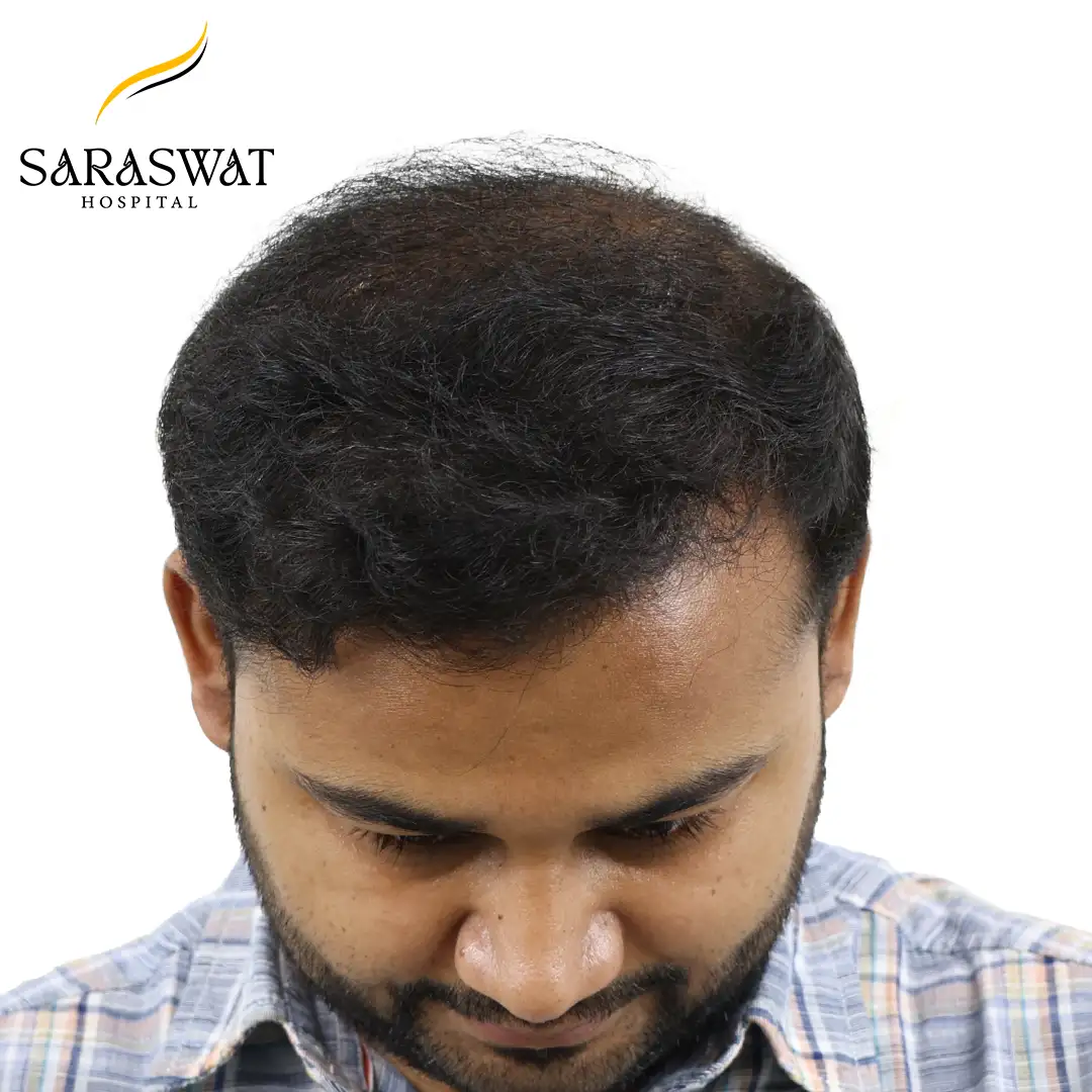 Top FUE Hair Transplant Result After Procedure