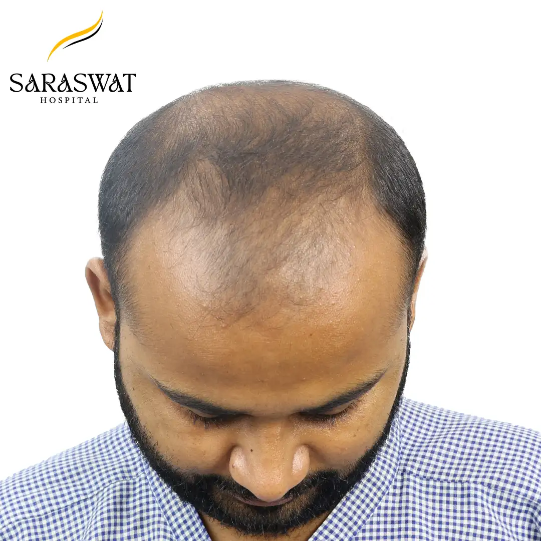 Top FUE Hair Transplant Result Before Procedure