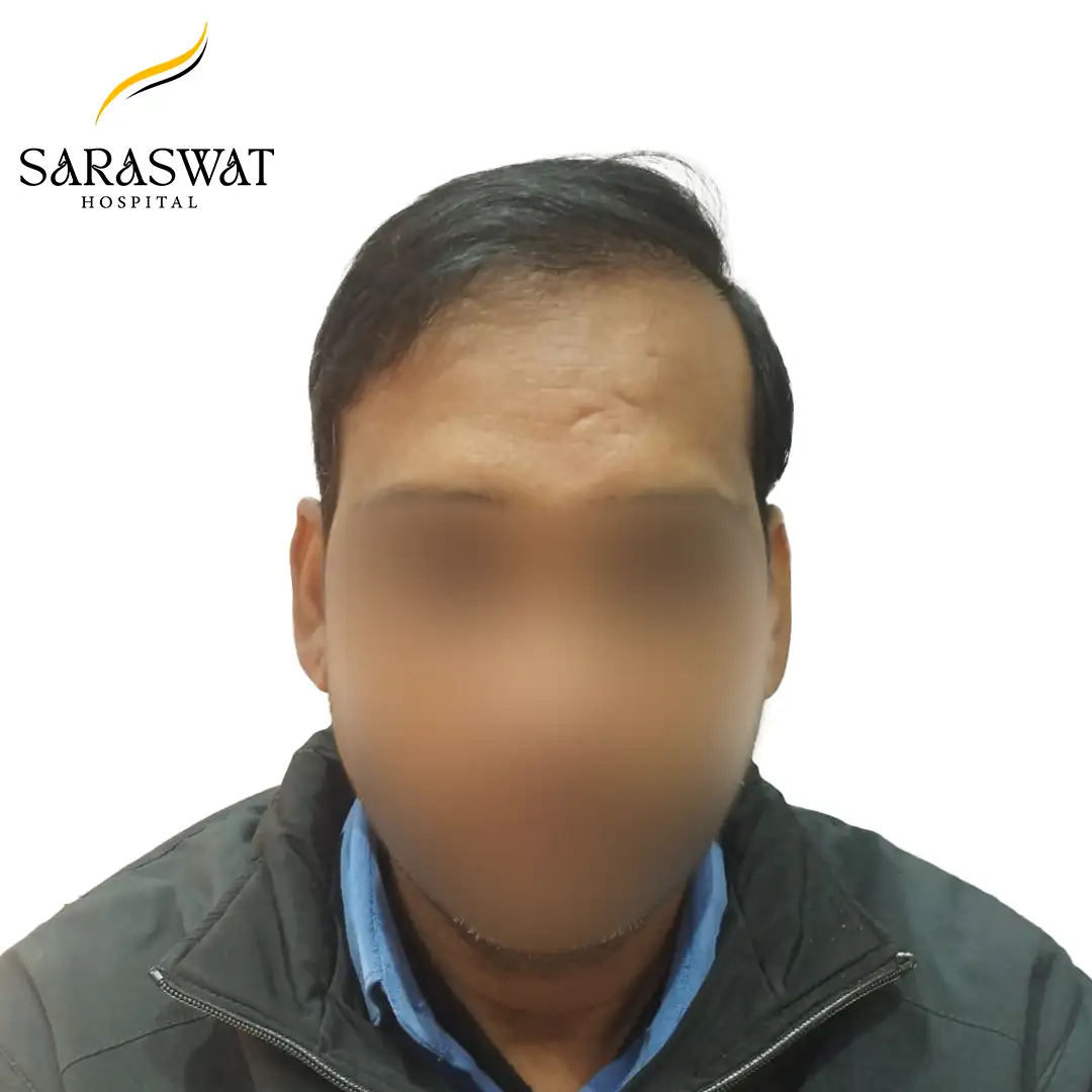 Front FUE Hair Transplant Result After Procedure