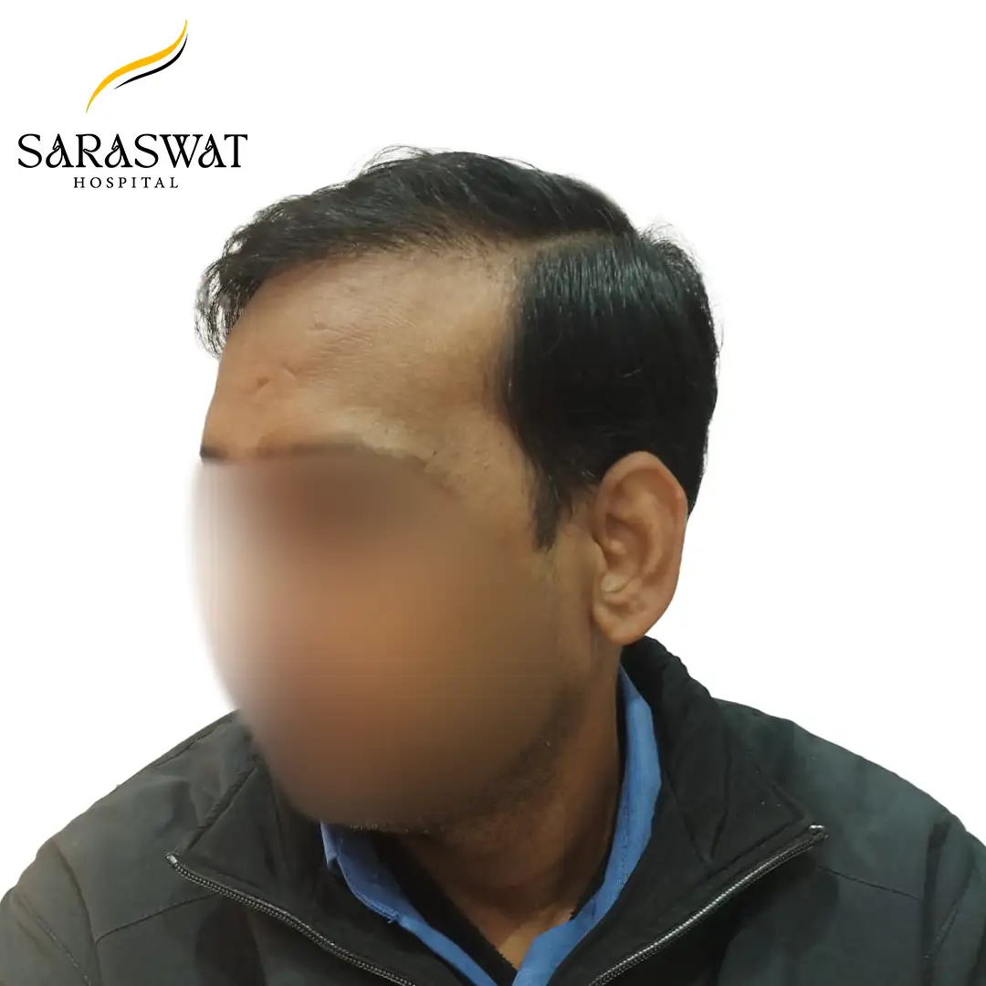 45 Degree Left FUE Hair Transplant Result After Procedure