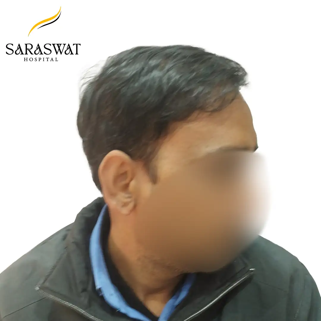 90 Degree Right FUE Hair Transplant Result After Procedure