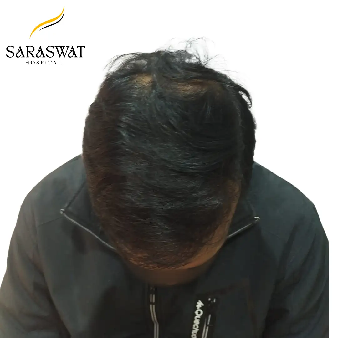 Hair Transplant Before and After Results