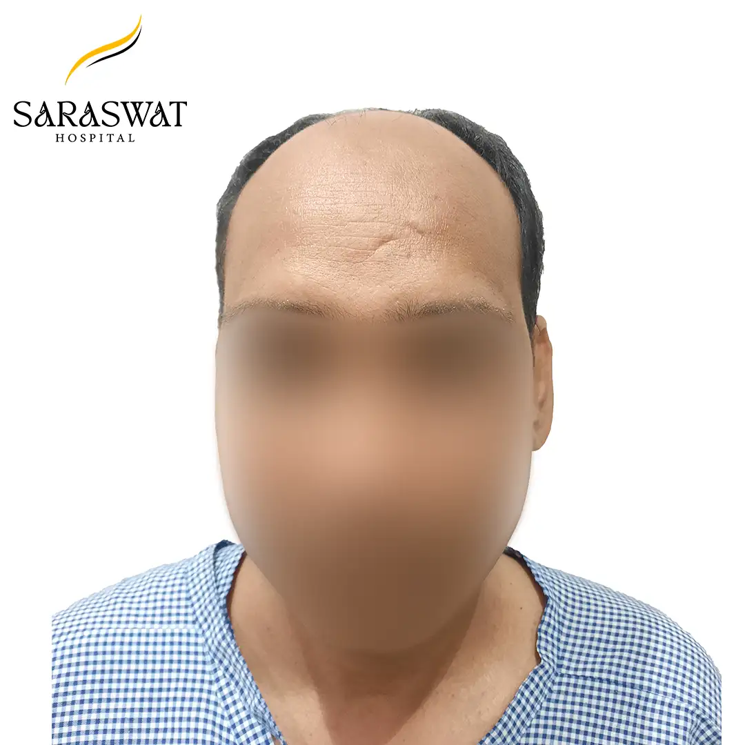 Front FUE Hair Transplant Result Before Procedure