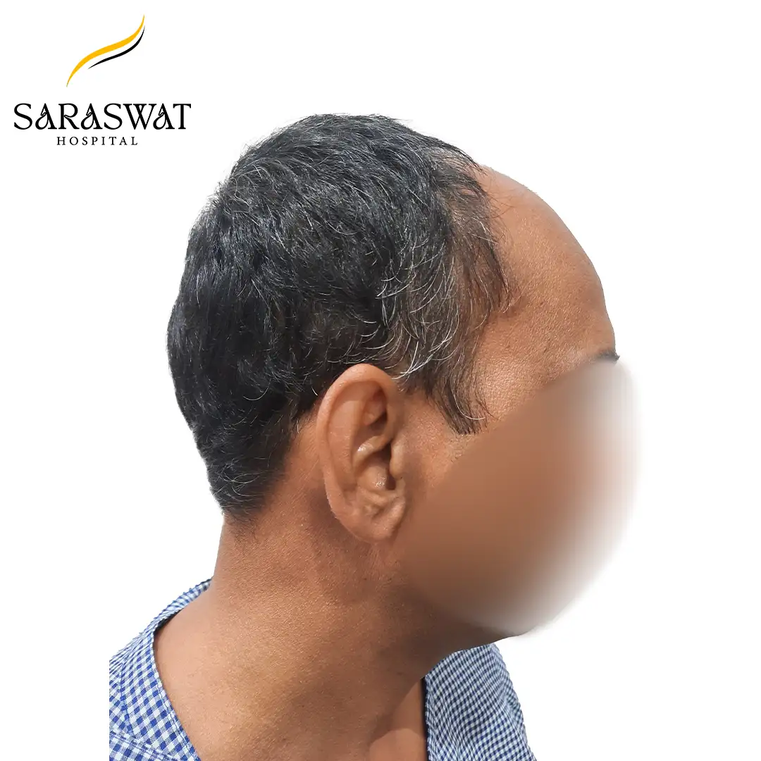 90 Degree Right FUE Hair Transplant Result Before Procedure