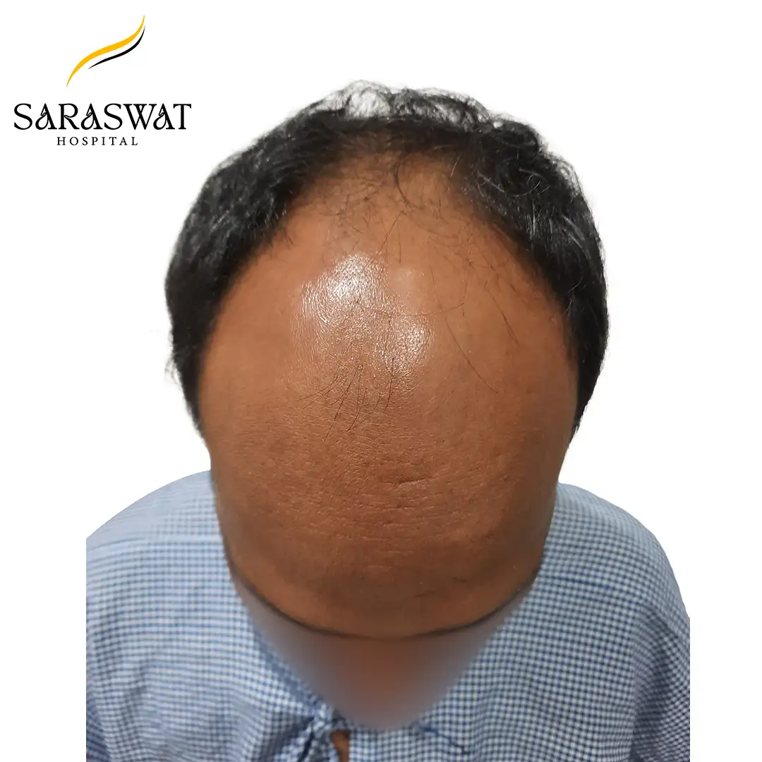 Top FUE Hair Transplant Result Before Procedure