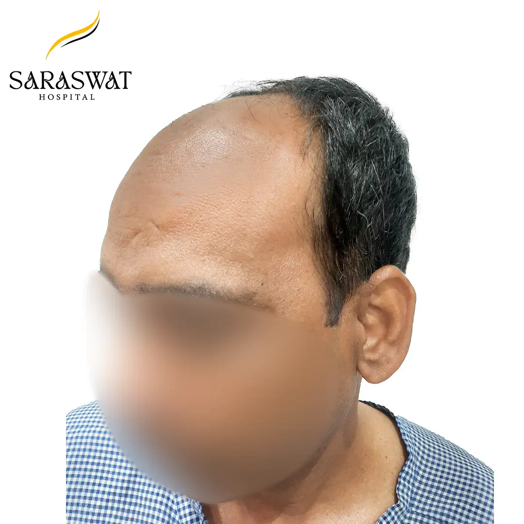 45 Degree Left FUE Hair Transplant Result Before Procedure