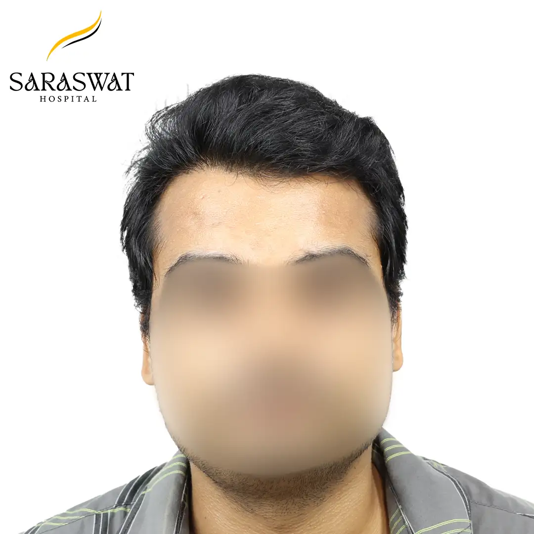 Front FUE Hair Transplant Result After Procedure