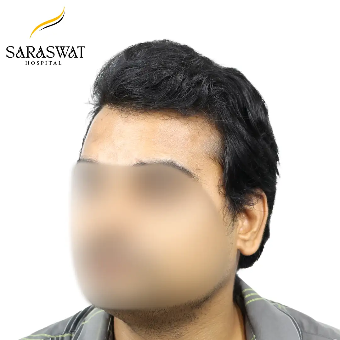 45 Degree Left FUE Hair Transplant Result After Procedure