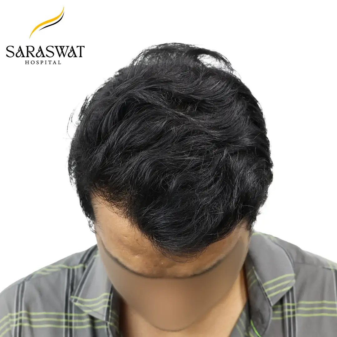Top FUE Hair Transplant Result After Procedure