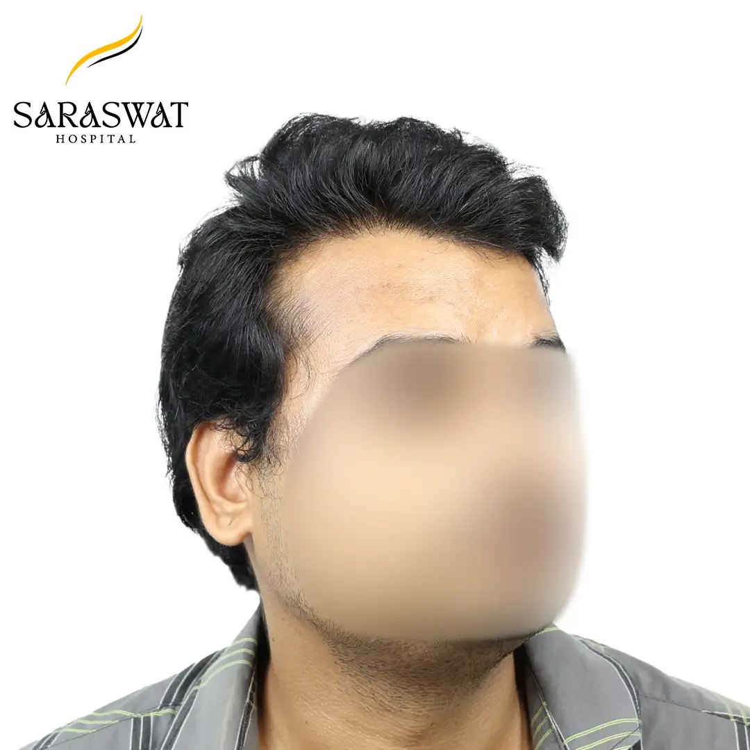 45 Degree Right FUE Hair Transplant Result After Procedure