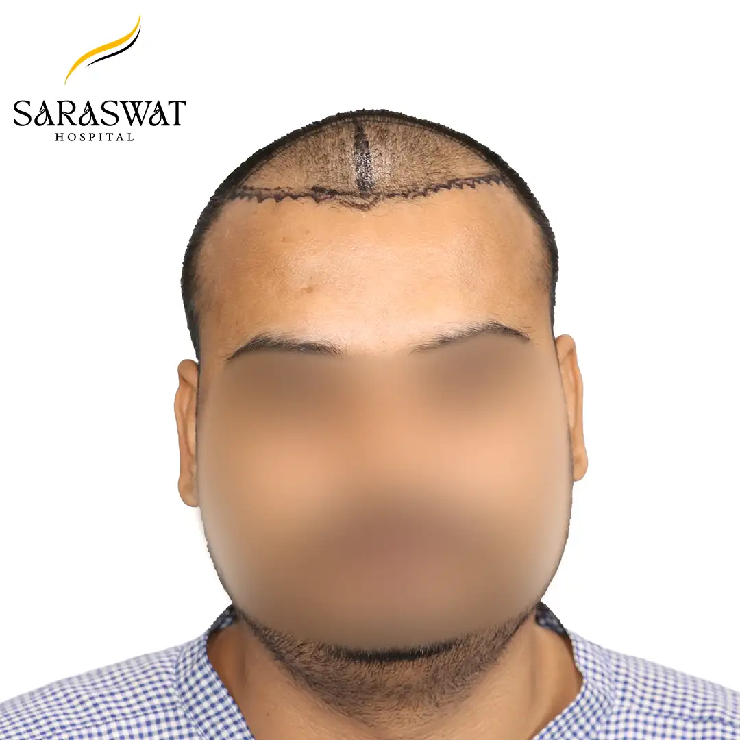 Front FUE Hair Transplant Result Before Procedure