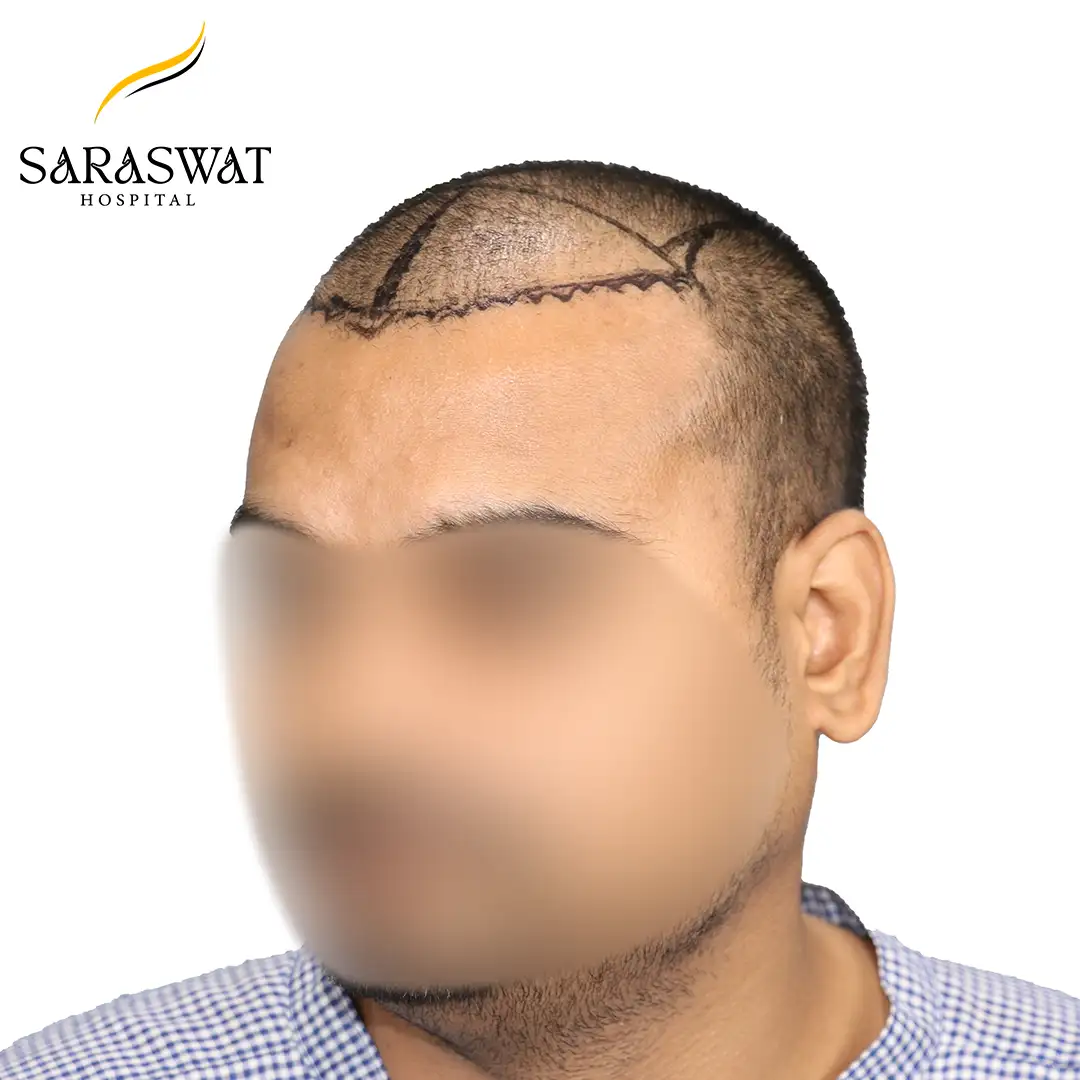 45 Degree Left FUE Hair Transplant Result Before Procedure