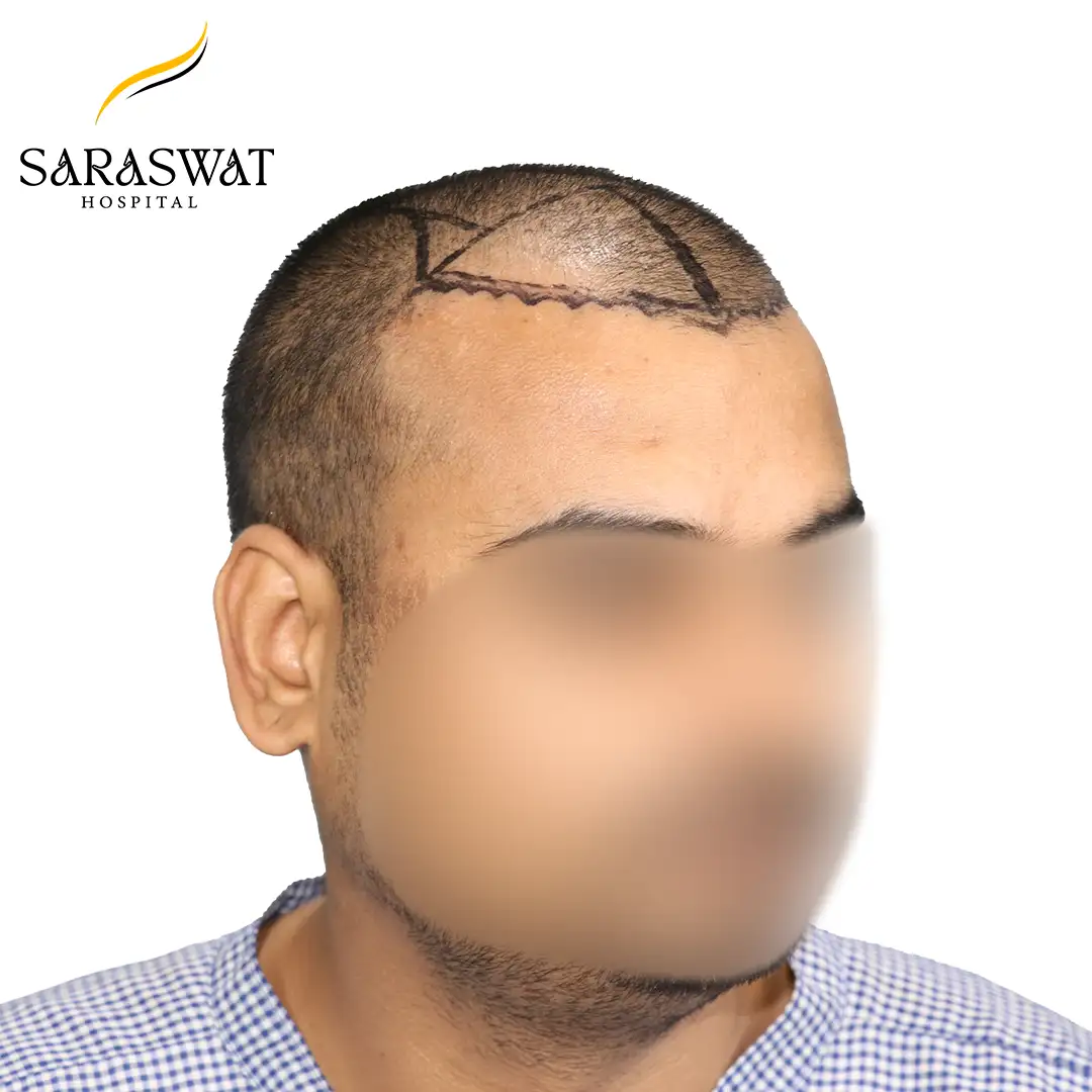 45 Degree Right FUE Hair Transplant Result Before Procedure