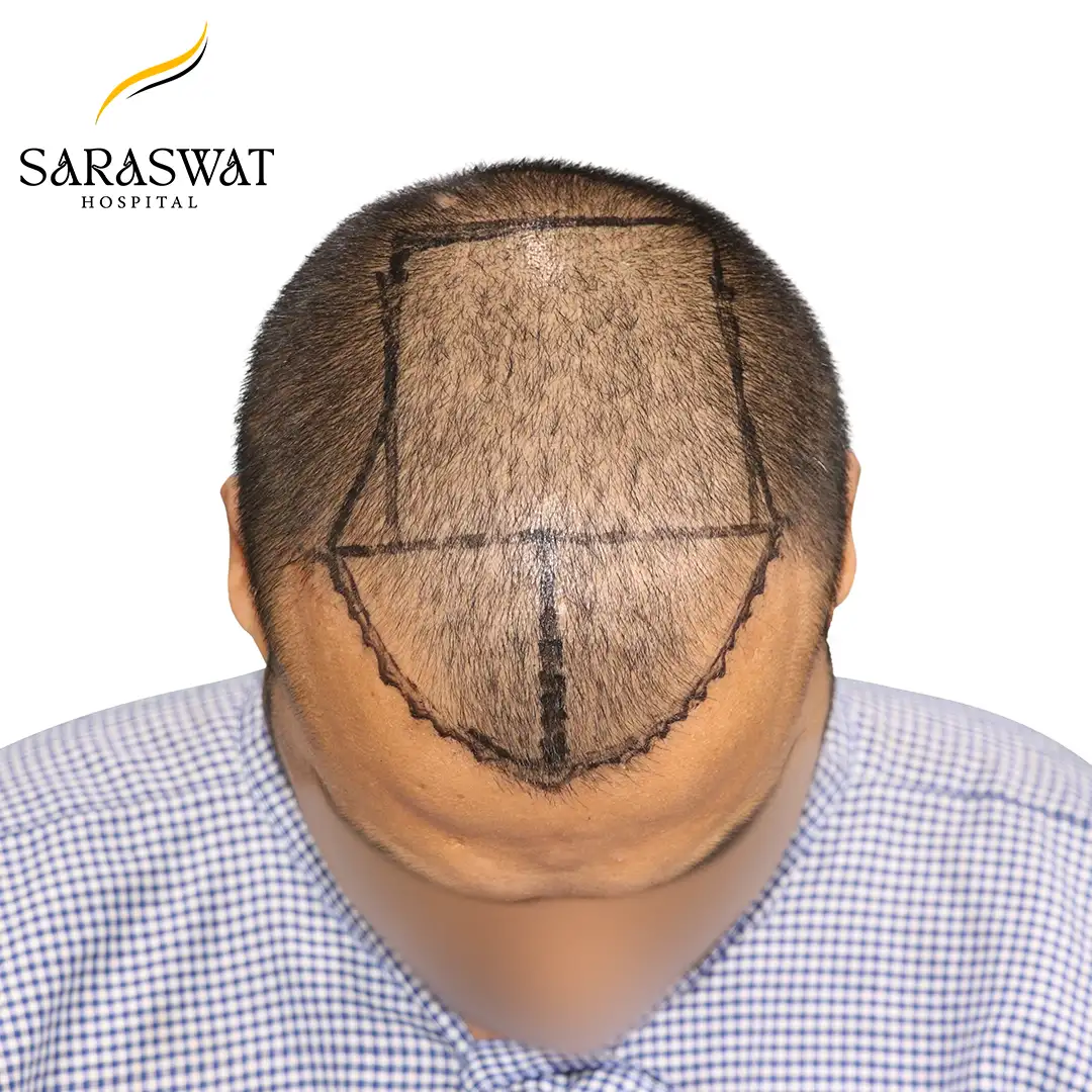 Top FUE Hair Transplant Result Before Procedure