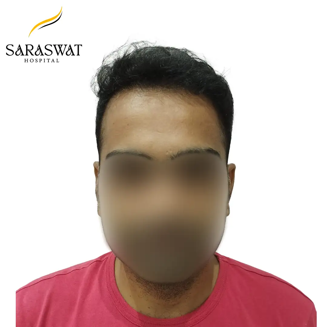 Front FUE Hair Transplant Result After Procedure