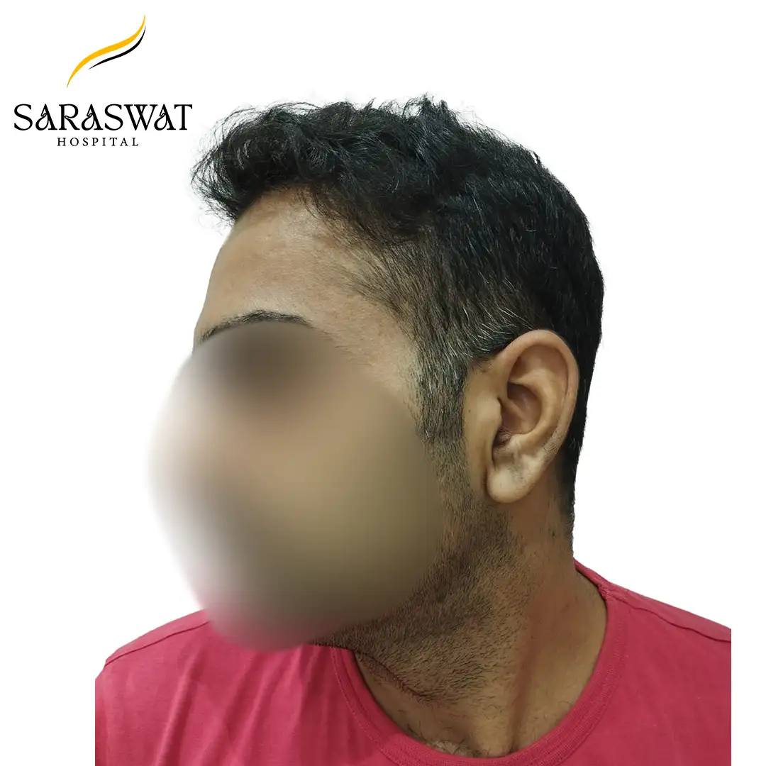 90 Degree Left FUE Hair Transplant Result After Procedure