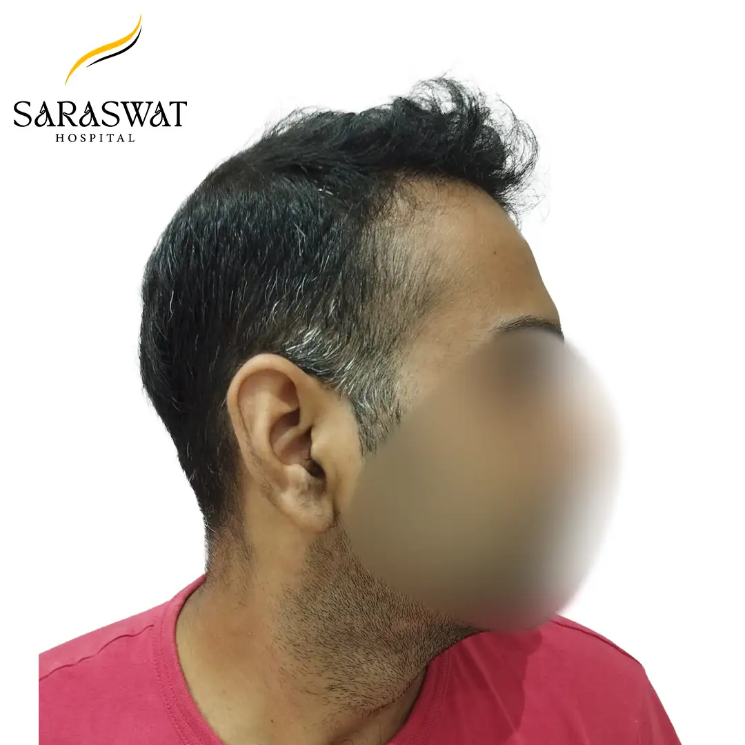 90 Degree Right FUE Hair Transplant Result After Procedure