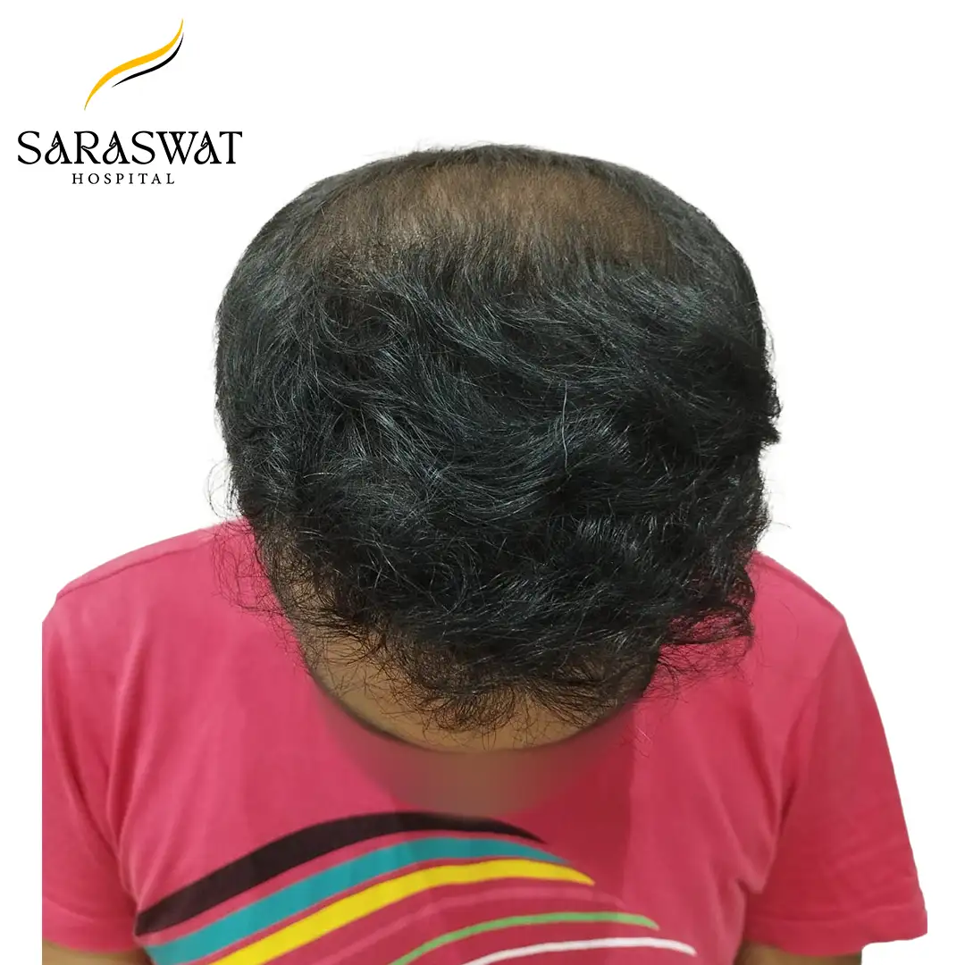 Top FUE Hair Transplant Result After Procedure