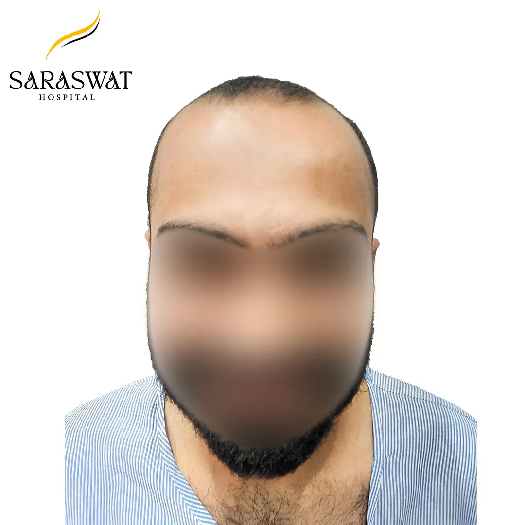 Front FUE Hair Transplant Result Before Procedure