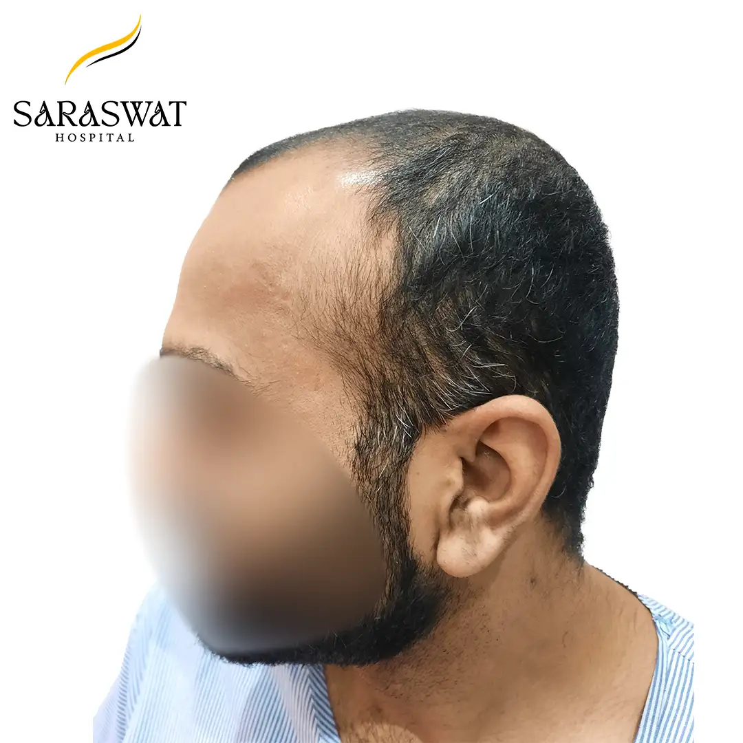 90 Degree Left FUE Hair Transplant Result Before Procedure