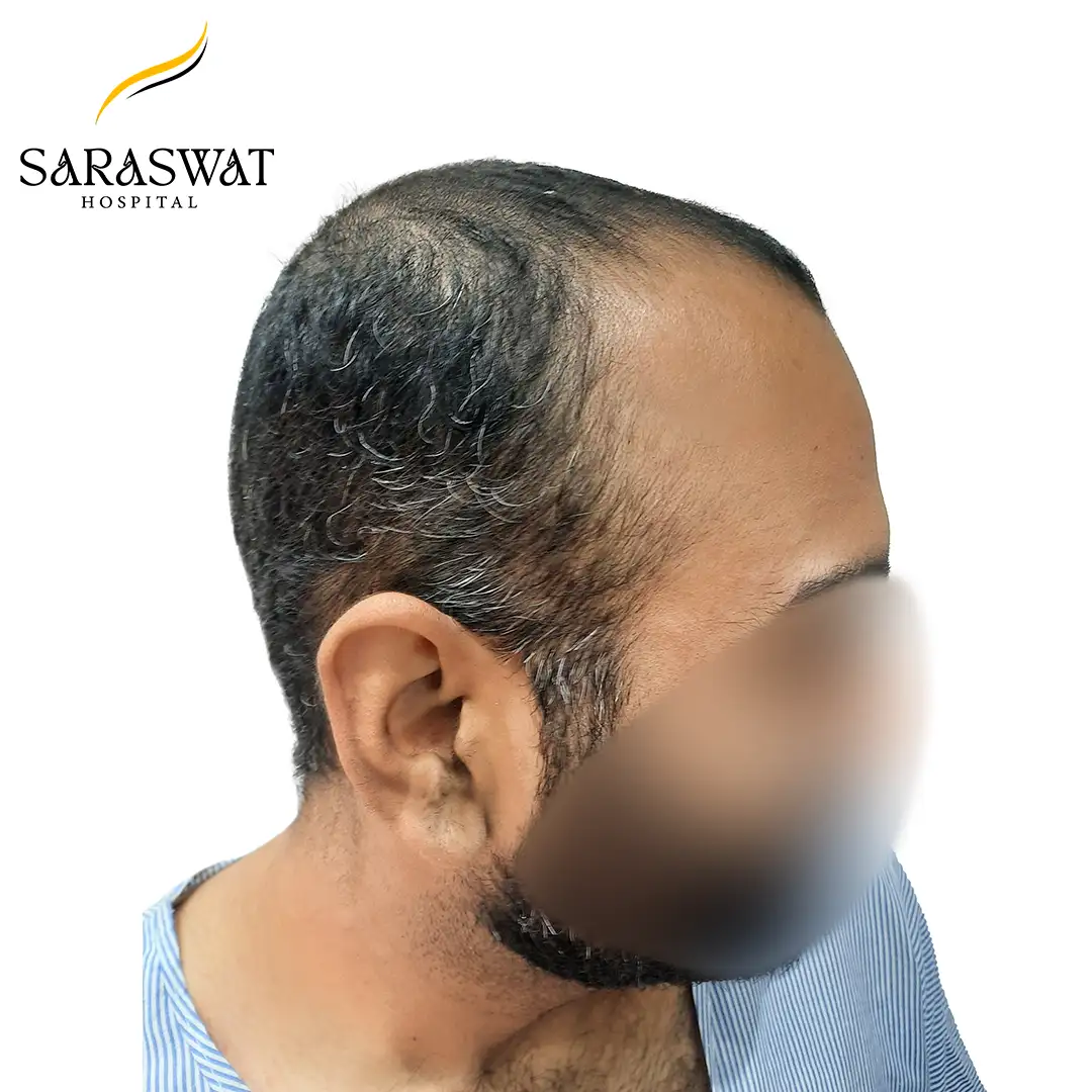 90 Degree Right FUE Hair Transplant Result Before Procedure