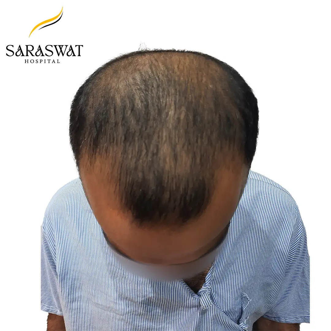 Top FUE Hair Transplant Result Before Procedure