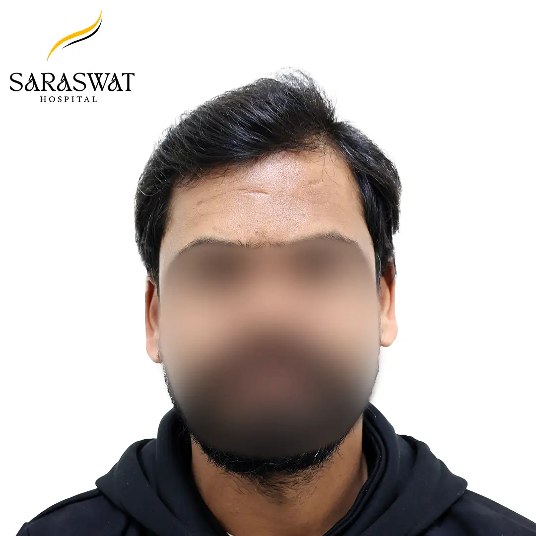 Hair Transplant Before After