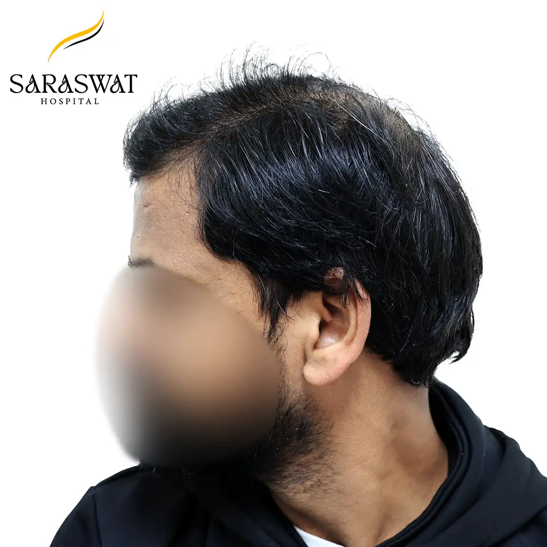 FUE Hair Transplant
