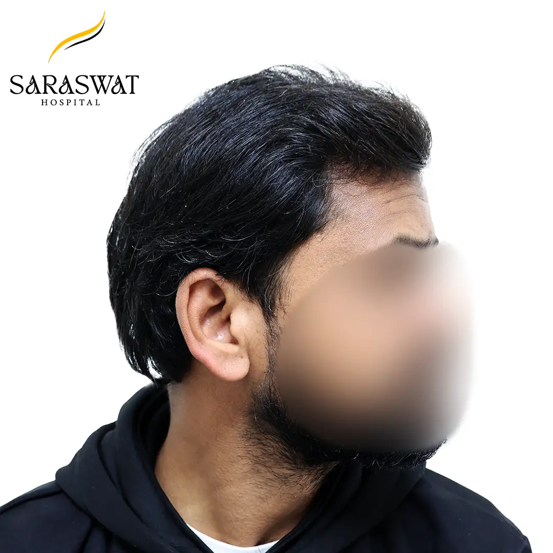 FUE Hair Transplant