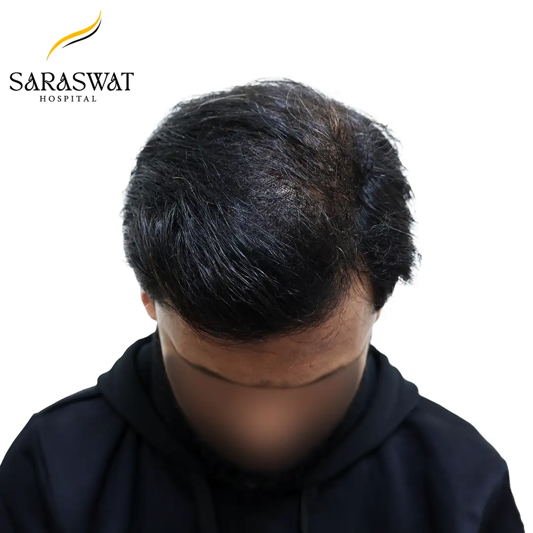 FUE Hair Transplant