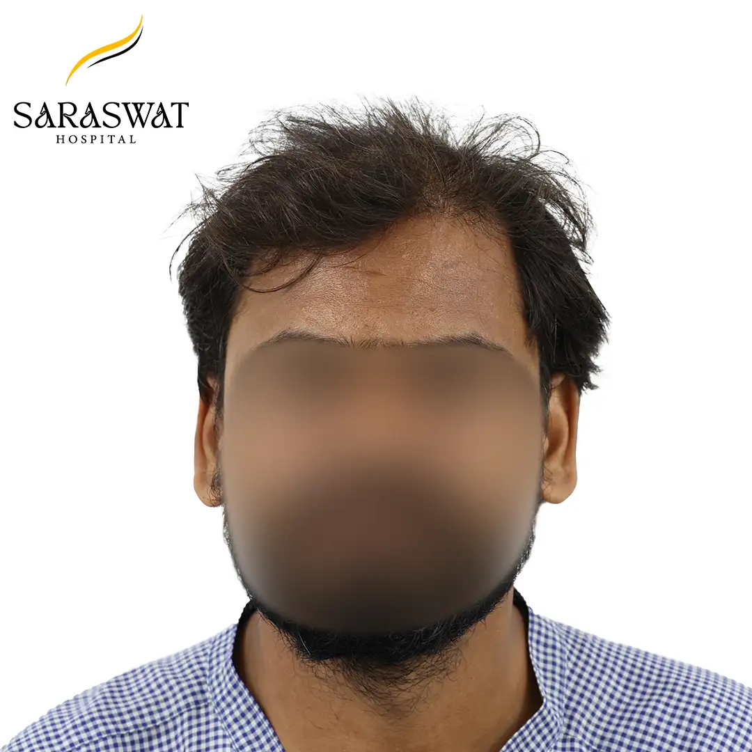 Front FUE Hair Transplant Result Before Procedure