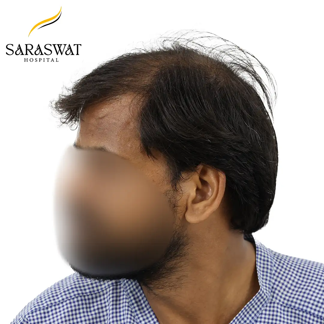 90 Degree Left FUE Hair Transplant Result Before Procedure