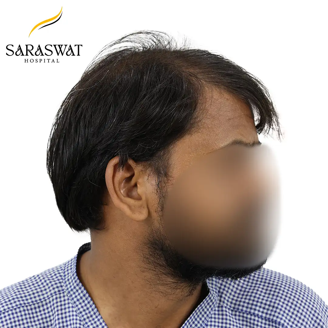 90 Degree Right FUE Hair Transplant Result Before Procedure