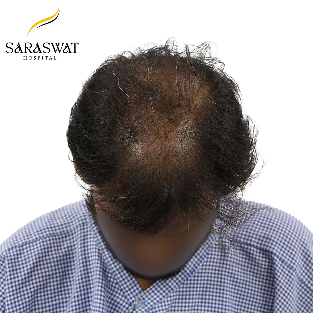 Top FUE Hair Transplant Result Before Procedure