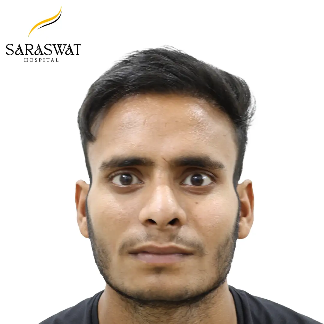 Front FUE Hair Transplant Result After Procedure