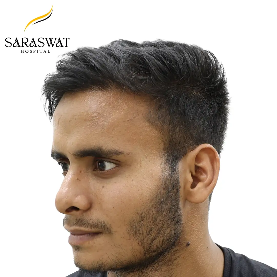 45 Degree Left FUE Hair Transplant Result After Procedure