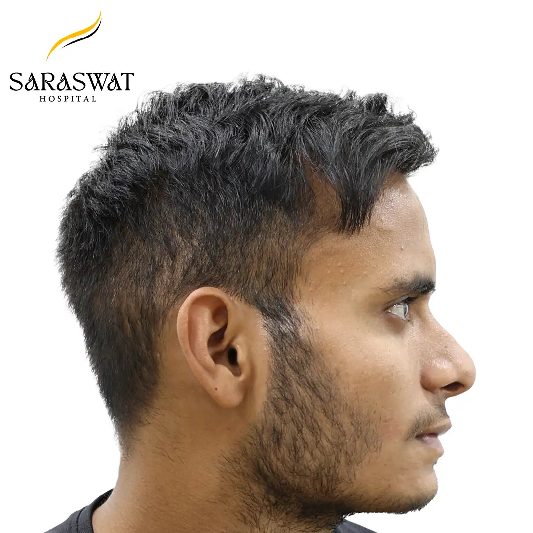 90 Degree Right FUE Hair Transplant Result After Procedure