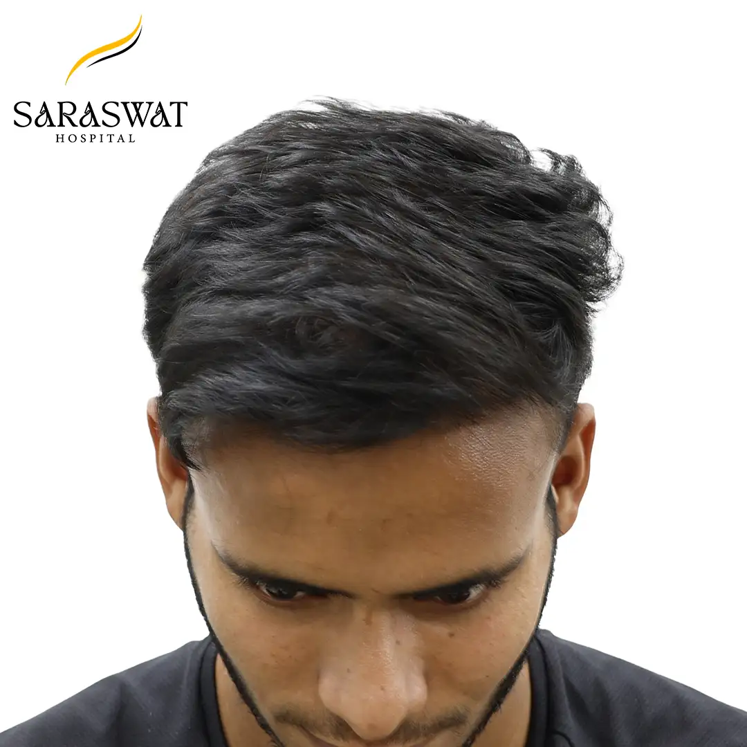 Top FUE Hair Transplant Result After Procedure