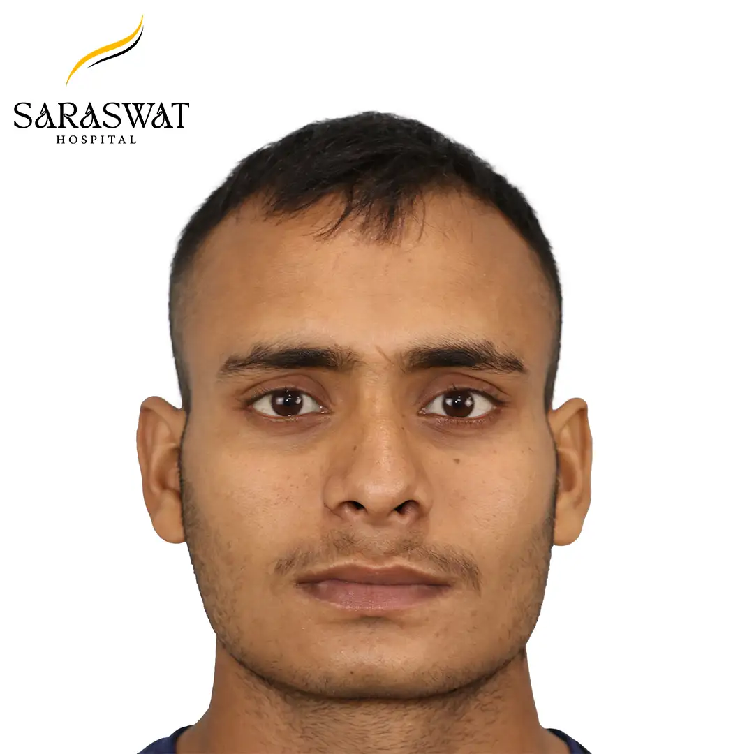 Front FUE Hair Transplant Result Before Procedure