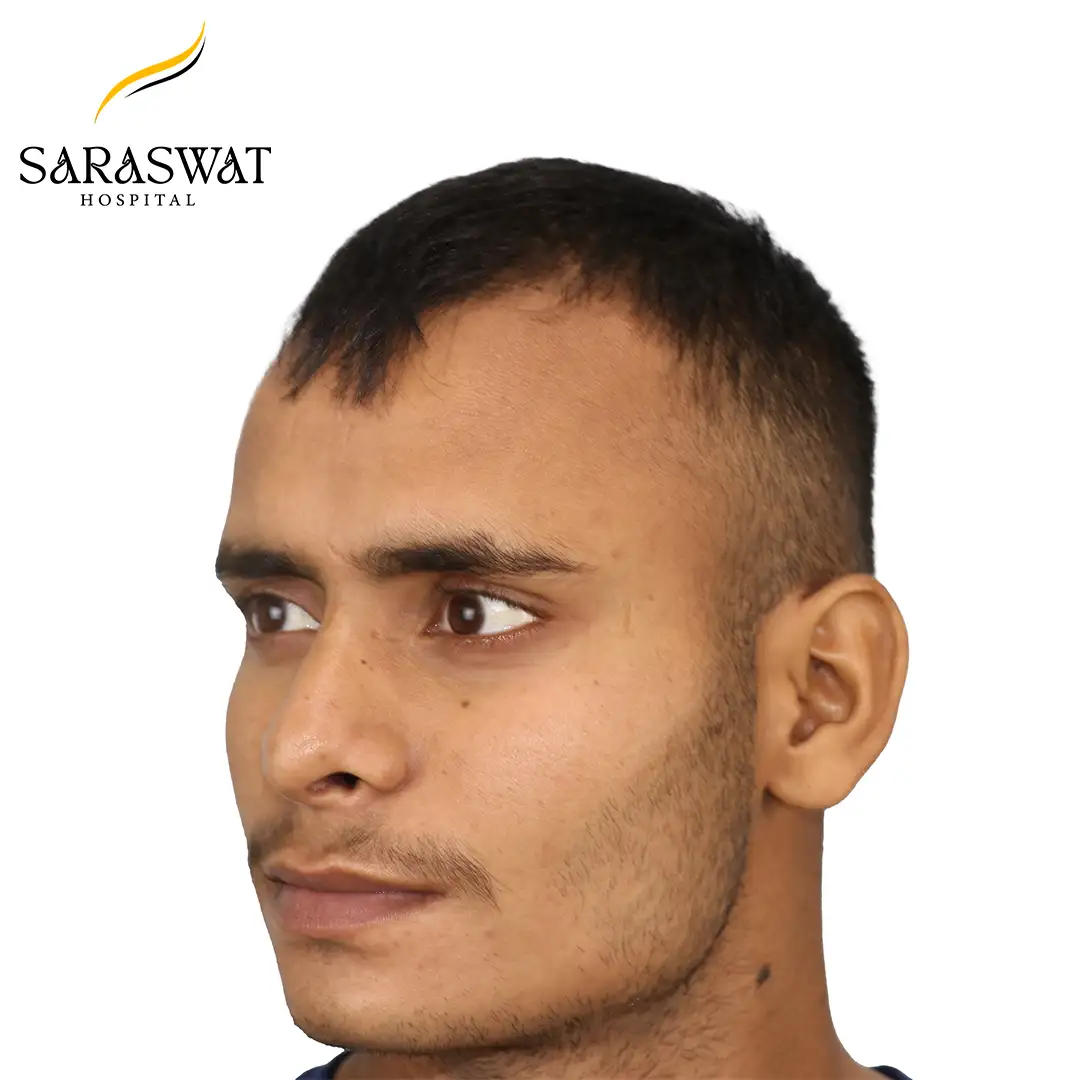 45 Degree Left FUE Hair Transplant Result Before Procedure