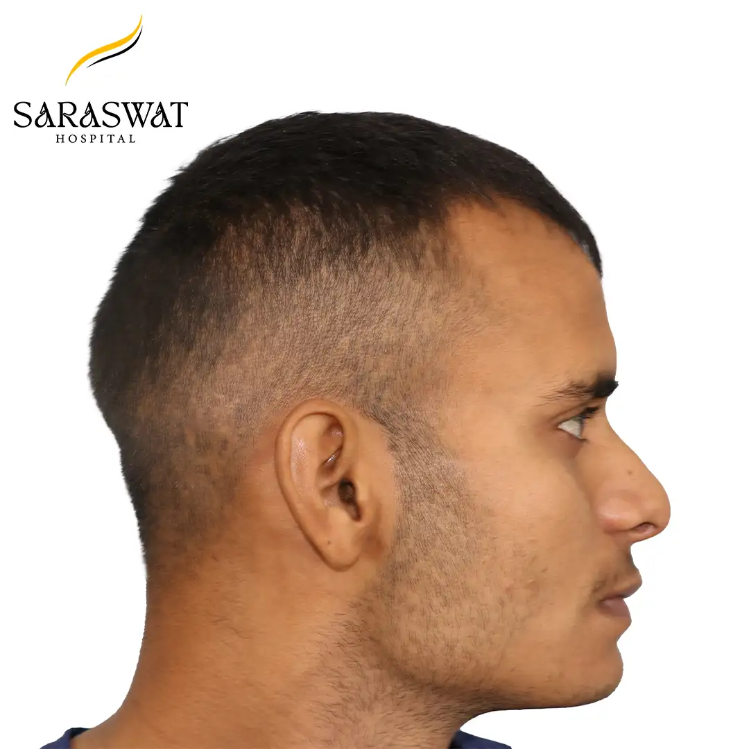 90 Degree Right FUE Hair Transplant Result Before Procedure