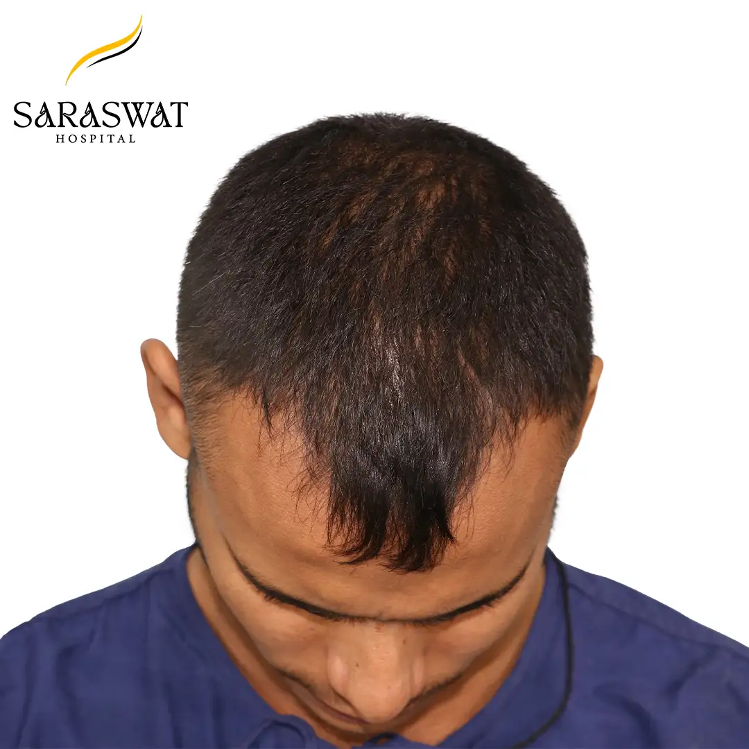 Top FUE Hair Transplant Result Before Procedure