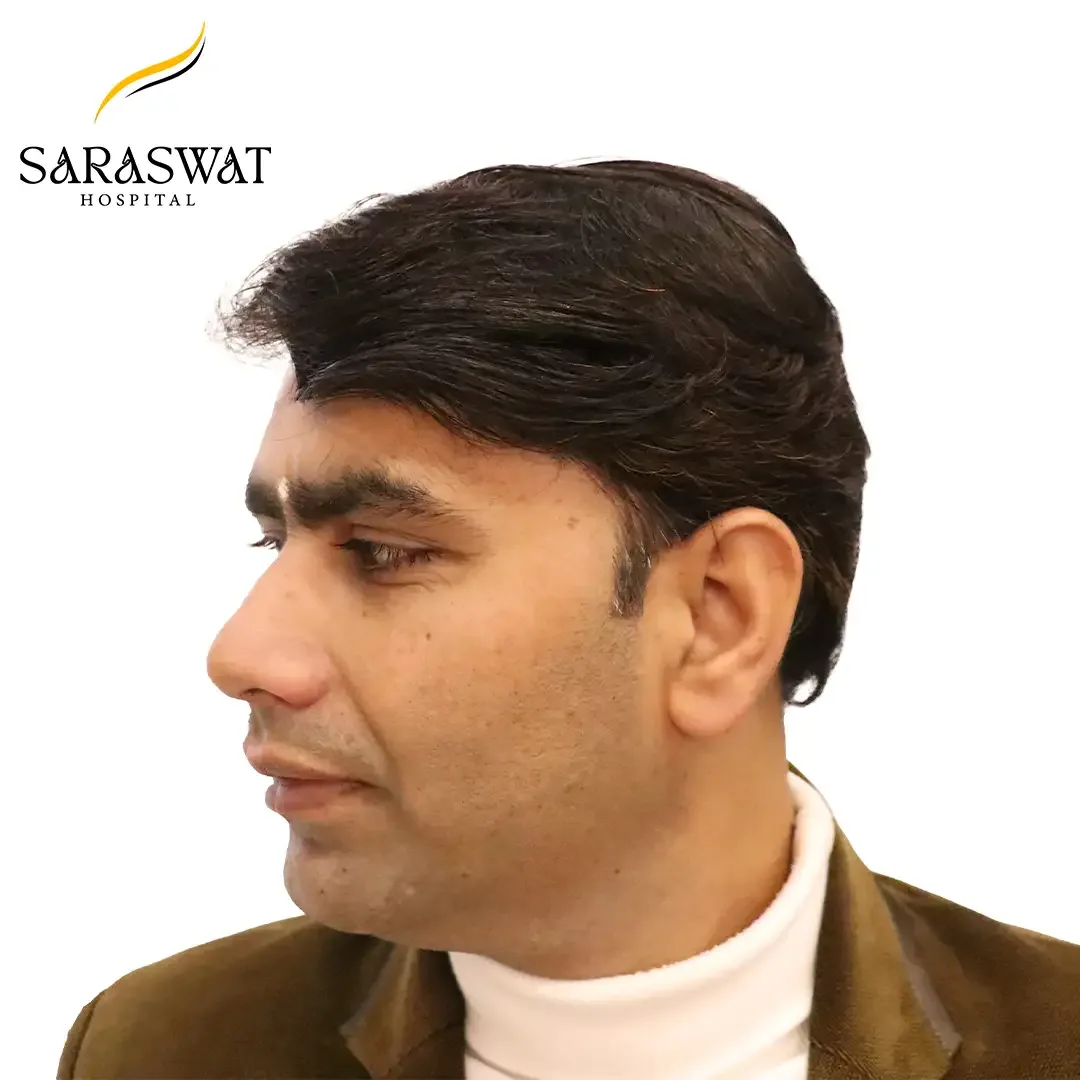 Hair Transplant Before and After Results